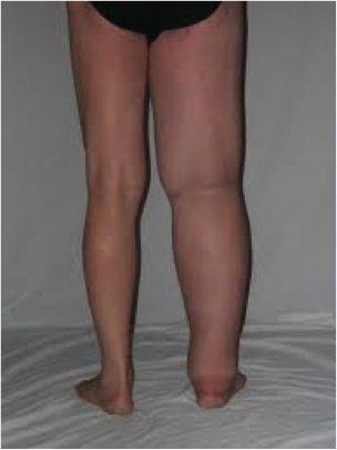 El linfedema es una enfermedad causada por la retención de liquido en tus brazos o piernas,  causado por una insuficiencia mecánica del sistema linfático; por lo que los tejidos se ven  inflamados) por la acumulación de linfa en ellos. Lo anterior traduce en una inflamación de los tejidos, generalmente en los brazos o en las piernas.